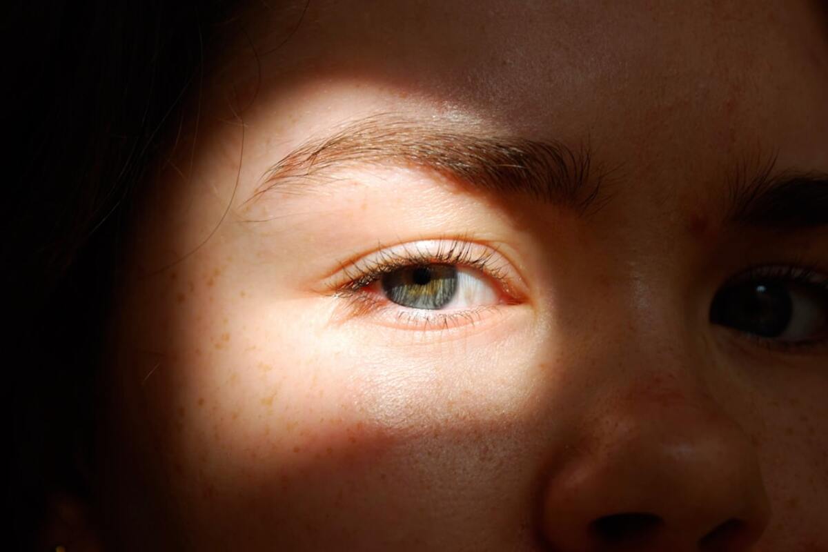 Why One Eyelid Suddenly Looks Smaller: A Simple Guide to Droopy Lid (Ptosis) and Puffy Swelling